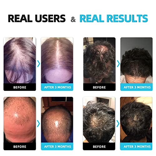 IHELMET Sistema de crescimento de cabelo a laser, capacete de crescimento de cabelo e boné a laser, tratamento